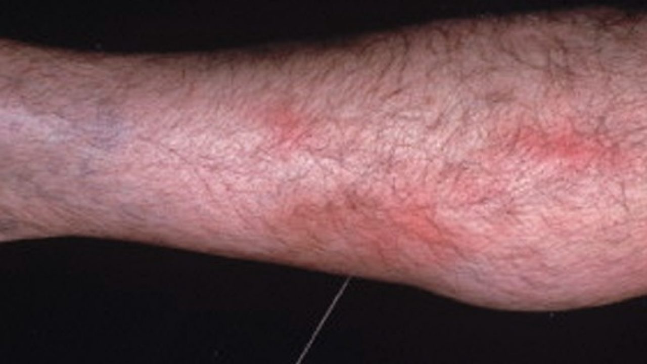 bandaj strâns în varicoza varicoza pe cauzele piciorului drept